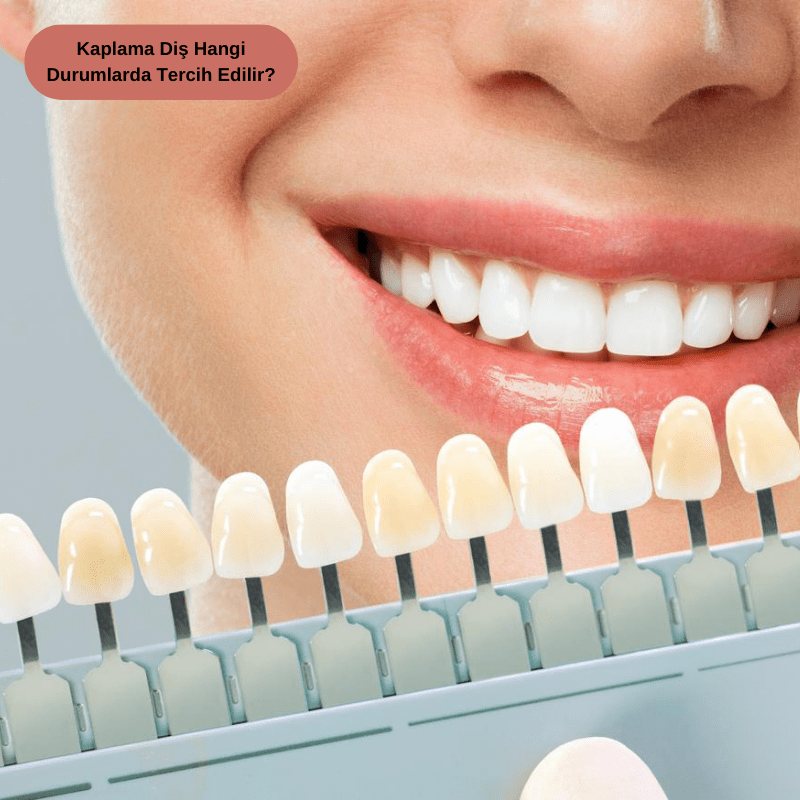 Kaplama Diş Hangi Durumlarda Tercih Edilir
