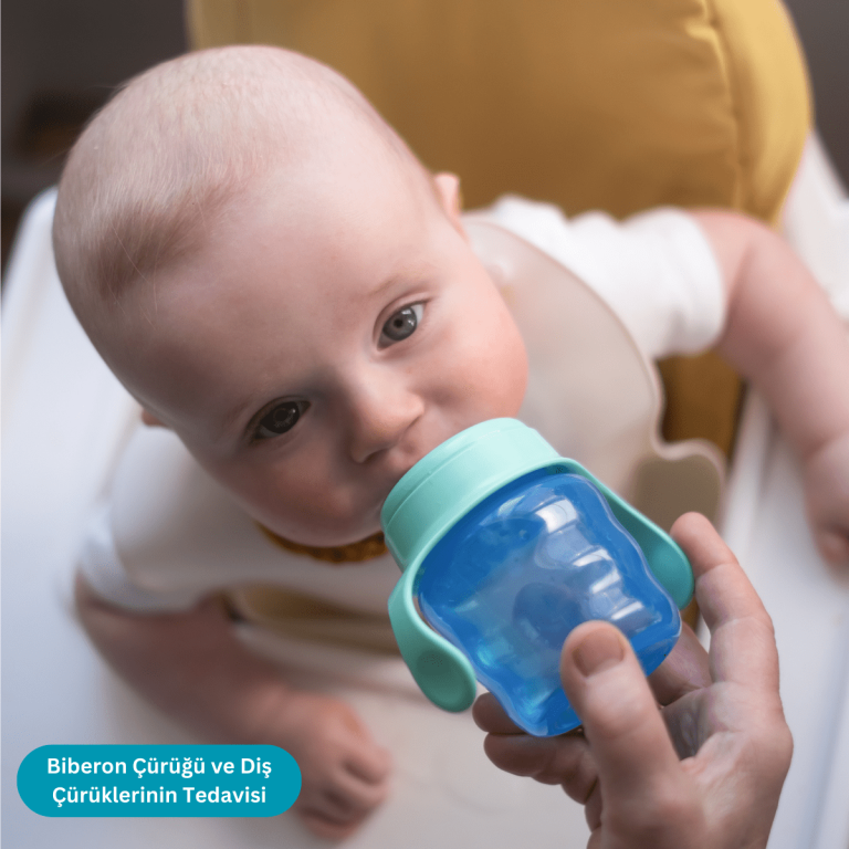 Biberon Çürüğü ve Diş Çürüklerinin Tedavisi